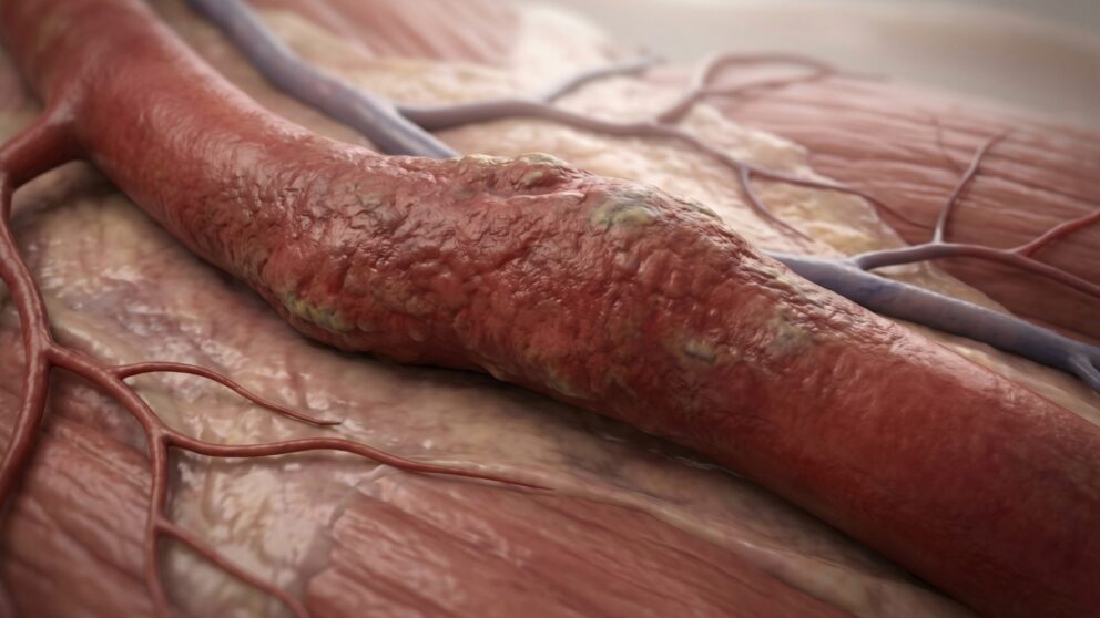 Arteriosklerose