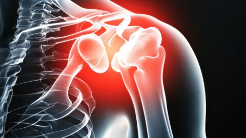 Frozen Shoulder