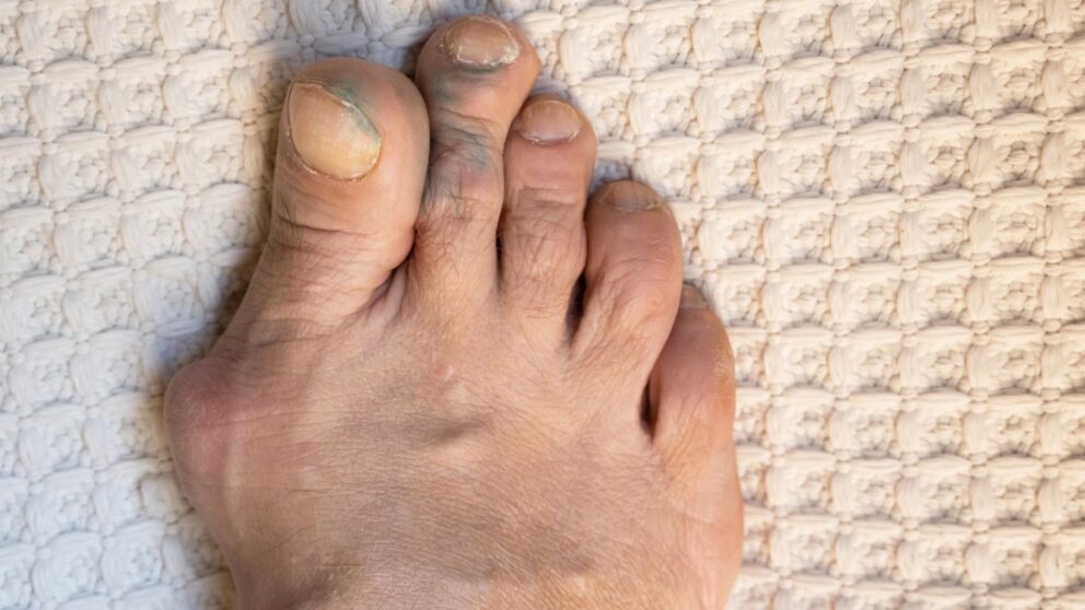 Hallux valgus