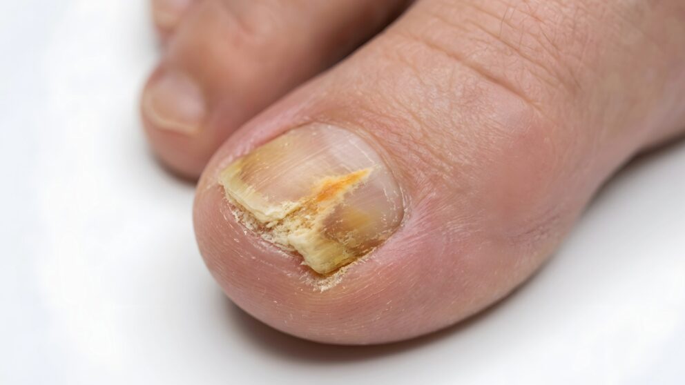 Nagelpilz