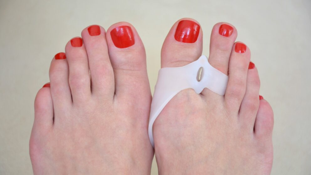 Hallux valgus: Kann man ihn mit Schienen aufhalten?