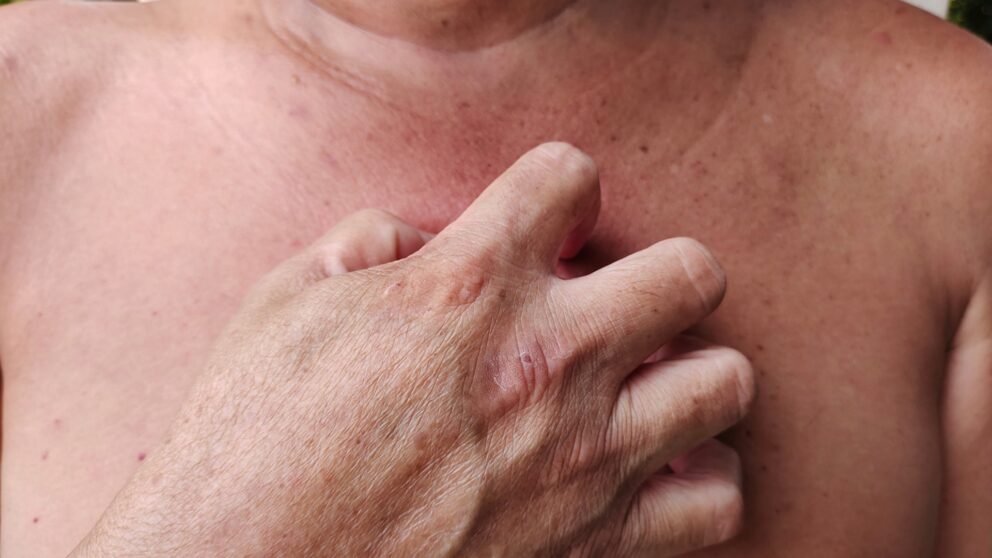 Hilfe bei diabetischen Hautproblemen