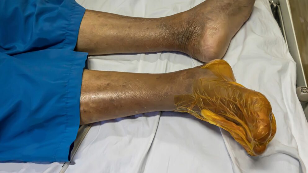 Wie die Sauerstoff-Therapie Füße vor der Amputation retten kann